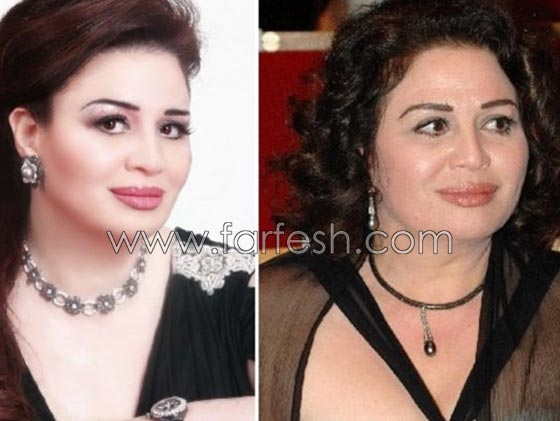 صور فنانات اجرين عمليات تجميل فاشلة نجم عنها التشويه الشلل والوفاة  صورة رقم 9