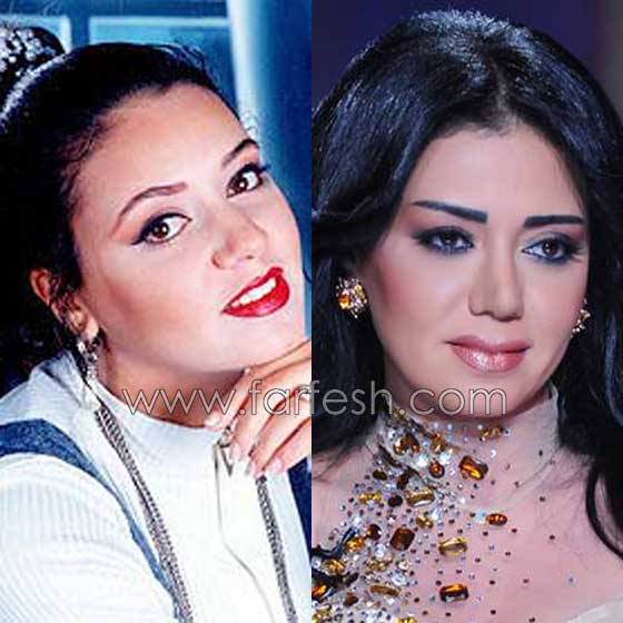صور فنانات اجرين عمليات تجميل فاشلة نجم عنها التشويه الشلل والوفاة  صورة رقم 7