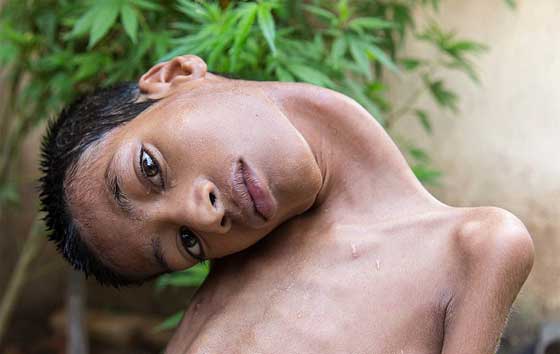 متبرعة بريطانية تنقذ الطفل صاحب الرقبة الملتوية ليعيش حياة طبيعية صورة رقم 6