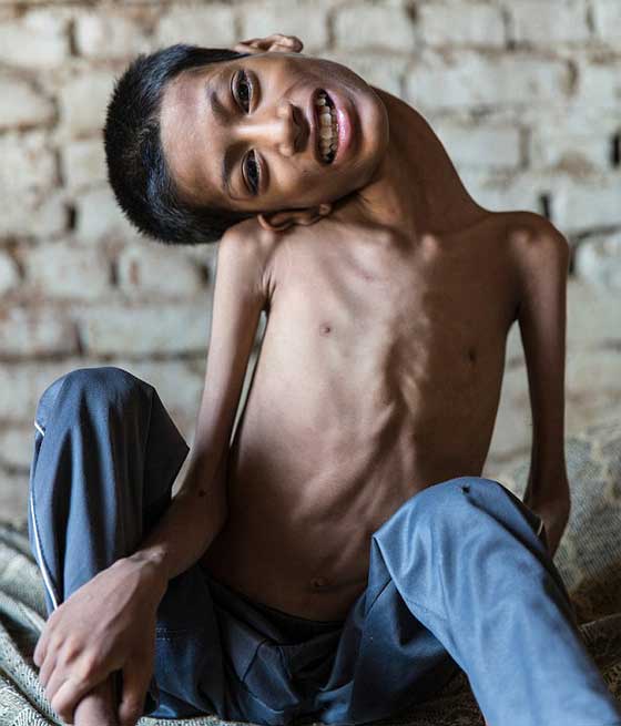 متبرعة بريطانية تنقذ الطفل صاحب الرقبة الملتوية ليعيش حياة طبيعية صورة رقم 8