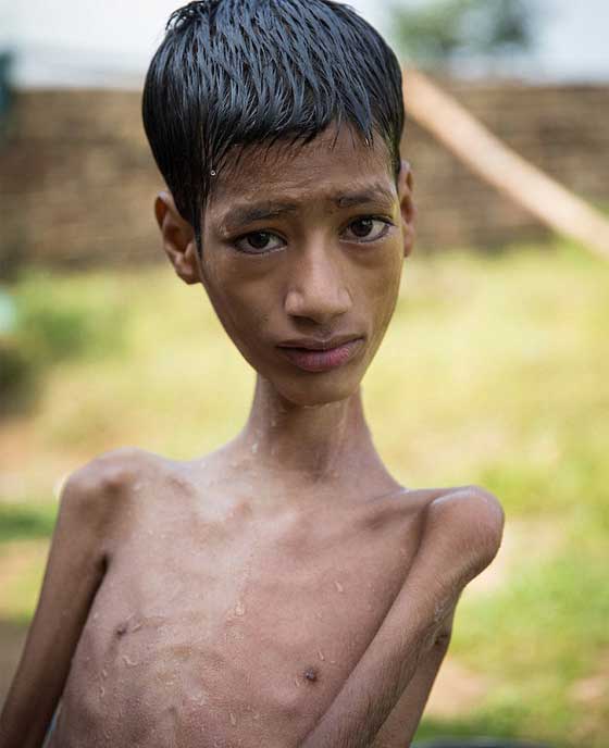 متبرعة بريطانية تنقذ الطفل صاحب الرقبة الملتوية ليعيش حياة طبيعية صورة رقم 7