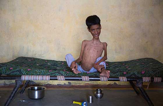 متبرعة بريطانية تنقذ الطفل صاحب الرقبة الملتوية ليعيش حياة طبيعية صورة رقم 9