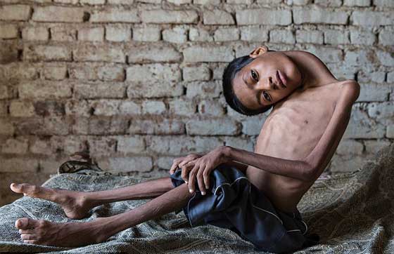 متبرعة بريطانية تنقذ الطفل صاحب الرقبة الملتوية ليعيش حياة طبيعية صورة رقم 10