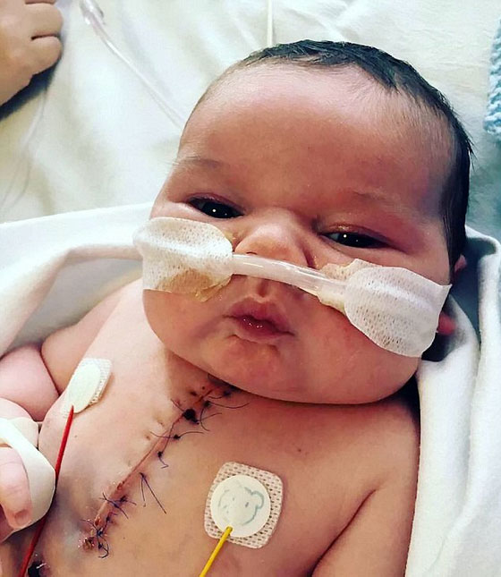 عملية جراحية معقدة لطفل عمره 4 ايام ولد بنصف قلب.. صور صورة رقم 5 عملية جراحية معقدة لطفل عمره 4 ايام ولد بنصف قلب.. صور صورة رقم 5