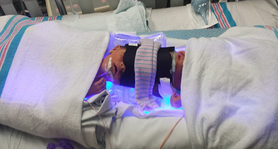 صور عملية جراحية نادرة لفصل توأم ملتصق من الرأس صورة رقم 5 صور عملية جراحية نادرة لفصل توأم ملتصق من الرأس صورة رقم 5