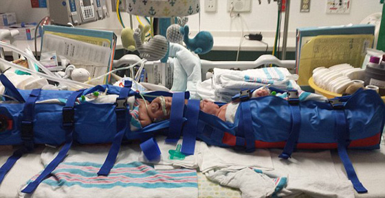 صور عملية جراحية نادرة لفصل توأم ملتصق من الرأس صورة رقم 6 صور عملية جراحية نادرة لفصل توأم ملتصق من الرأس صورة رقم 6