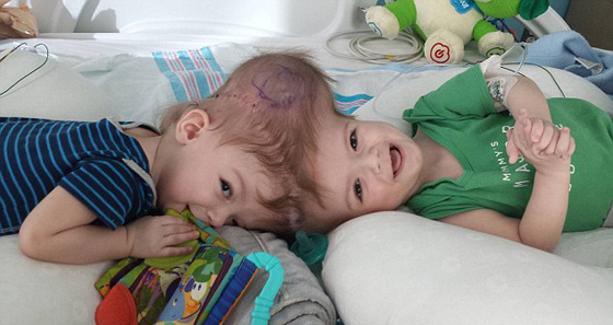 صور عملية جراحية نادرة لفصل توأم ملتصق من الرأس صورة رقم 3 صور عملية جراحية نادرة لفصل توأم ملتصق من الرأس صورة رقم 3