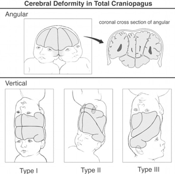 صور عملية جراحية نادرة لفصل توأم ملتصق من الرأس صورة رقم 11 صور عملية جراحية نادرة لفصل توأم ملتصق من الرأس صورة رقم 11