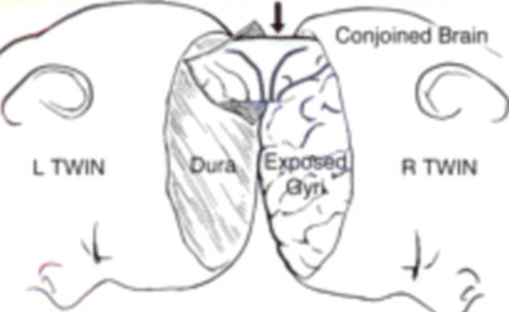صور عملية جراحية نادرة لفصل توأم ملتصق من الرأس صورة رقم 10 صور عملية جراحية نادرة لفصل توأم ملتصق من الرأس صورة رقم 10