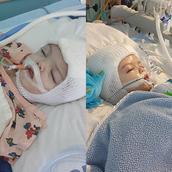 صور عملية جراحية نادرة لفصل توأم ملتصق من الرأس صورة رقم 1 صور عملية جراحية نادرة لفصل توأم ملتصق من الرأس صورة رقم 1