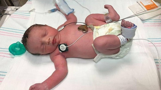 طفلة ولدت مرتين.. اجريت لها جراحة واعيدت الى رحم امها صورة رقم 6