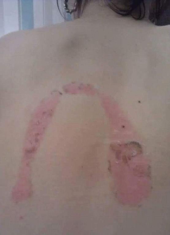 طلبت من حبيبها ان يغسل الصحون فحرق ظهرها بالمكواة!! صورة رقم 4