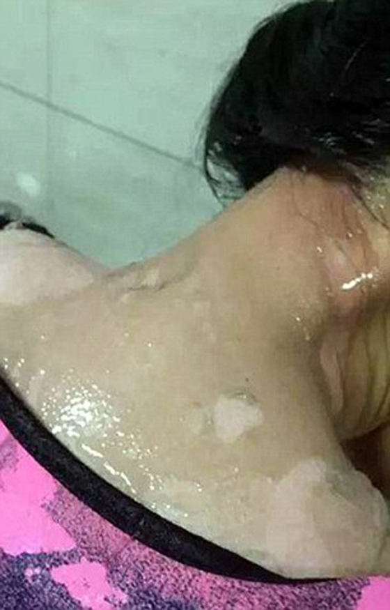 35 الف دولار تعويض لامراة سكب عليها نادل في مطعم ماء مغليا صورة رقم 7