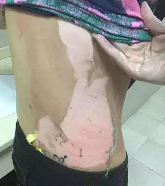 35 الف دولار تعويض لامراة سكب عليها نادل في مطعم ماء مغليا صورة رقم 6