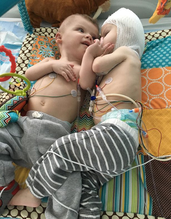 طفلان ملتصقان يرى الواحد منهما وجه توأمه لاول بعد فصلهما! فيديو صورة رقم 1