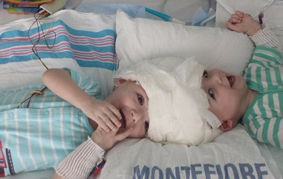 طفلان ملتصقان يرى الواحد منهما وجه توأمه لاول بعد فصلهما! فيديو صورة رقم 12