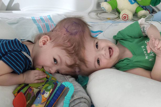 طفلان ملتصقان يرى الواحد منهما وجه توأمه لاول بعد فصلهما! فيديو صورة رقم 7