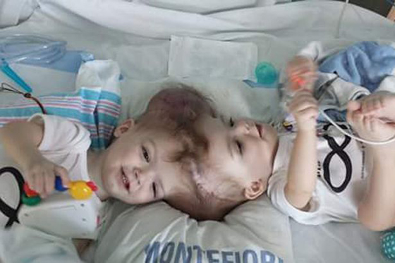 طفلان ملتصقان يرى الواحد منهما وجه توأمه لاول بعد فصلهما! فيديو صورة رقم 8