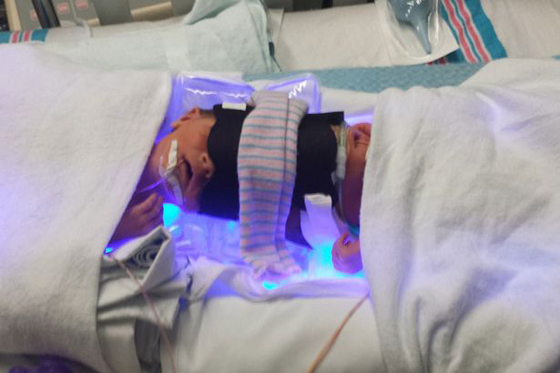 طفلان ملتصقان يرى الواحد منهما وجه توأمه لاول بعد فصلهما! فيديو صورة رقم 9