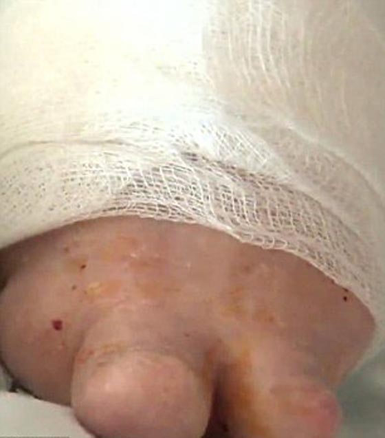 على فراش الموت.. شابة  تروي كيف سكب صديقها الوقود عليها واحرقها! صورة رقم 10