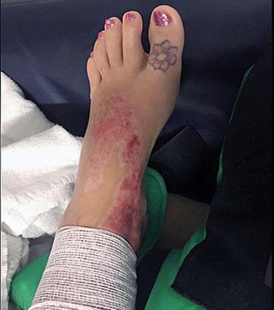 على فراش الموت.. شابة  تروي كيف سكب صديقها الوقود عليها واحرقها! صورة رقم 4