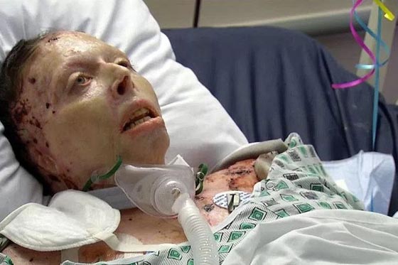 على فراش الموت.. شابة  تروي كيف سكب صديقها الوقود عليها واحرقها! صورة رقم 2