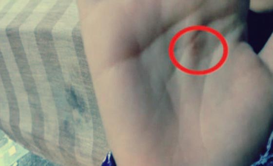  طالبة تتهم معلمة بإطفاء عود كبريت بيدها: ضربتني بالخرطوم على الحرق صورة رقم 1