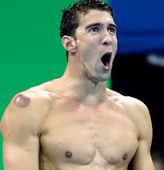 آثار الحجامة تظهر على اجساد الاولمبيين فما هو سرّها وسحرها؟ صورة رقم 2