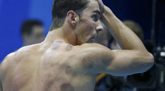 آثار الحجامة تظهر على اجساد الاولمبيين فما هو سرّها وسحرها؟ صورة رقم 3