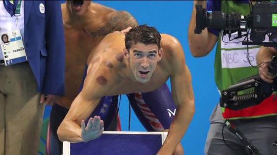 آثار الحجامة تظهر على اجساد الاولمبيين فما هو سرّها وسحرها؟ صورة رقم 6