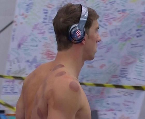 آثار الحجامة تظهر على اجساد الاولمبيين فما هو سرّها وسحرها؟ صورة رقم 8