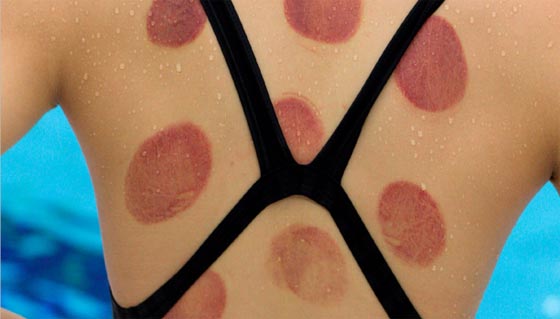 آثار الحجامة تظهر على اجساد الاولمبيين فما هو سرّها وسحرها؟ صورة رقم 1