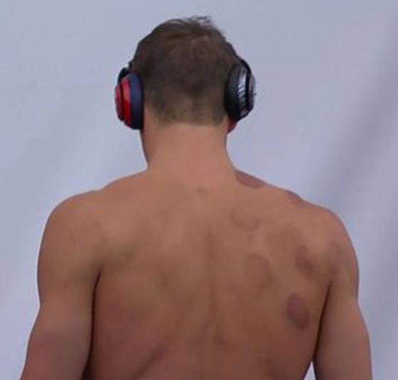 آثار الحجامة تظهر على اجساد الاولمبيين فما هو سرّها وسحرها؟ صورة رقم 9