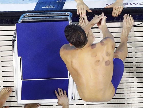 آثار الحجامة تظهر على اجساد الاولمبيين فما هو سرّها وسحرها؟ صورة رقم 13