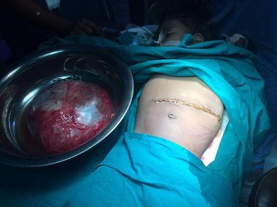  اكتشاف جنين وزنه 3.5 كغم في بطن طفلة.. فيديو صورة رقم 2