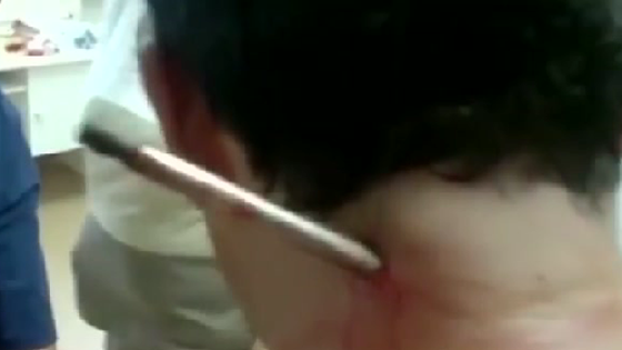 فيديو صادم.. سهم يخترق كتف صياد روسي ويخرج من عنقه صورة رقم 2 فيديو صادم.. سهم يخترق كتف صياد روسي ويخرج من عنقه صورة رقم 2