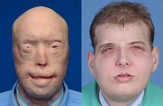 اول عملية زراعة وجه لرجل اطفاء امريكي تتكلل بالنجاح صورة رقم 1