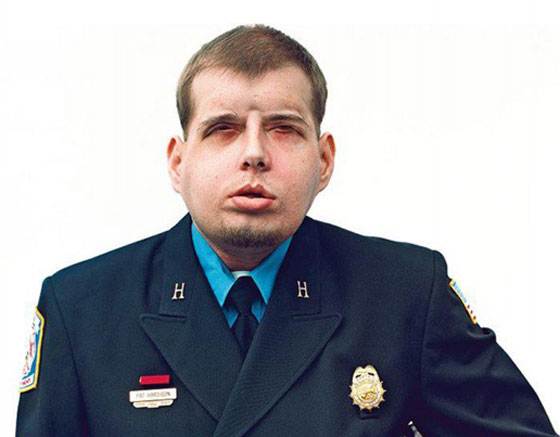 اول عملية زراعة وجه لرجل اطفاء امريكي تتكلل بالنجاح صورة رقم 7