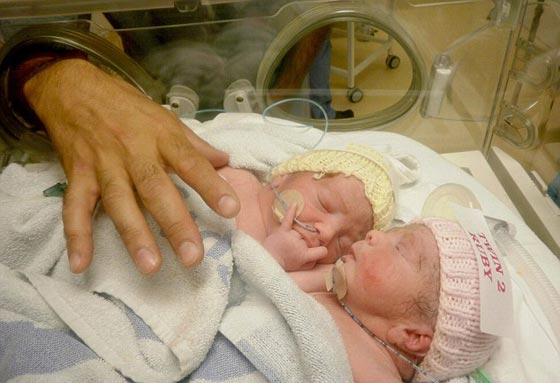 صور وفيديو الطفلتين التوأم روبي وروزي في المدرسة بعد عملية فصلهما صورة رقم 9 صور وفيديو الطفلتين التوأم روبي وروزي في المدرسة بعد عملية فصلهما صورة رقم 9