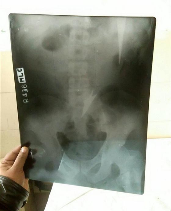 نجاة شاب من الموت باعجوبة بعد ان ضربه شقيقه 3 سهام في بطنه.. صور صورة رقم 4