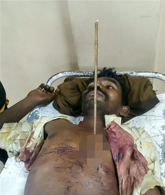 نجاة شاب من الموت باعجوبة بعد ان ضربه شقيقه 3 سهام في بطنه.. صور صورة رقم 2