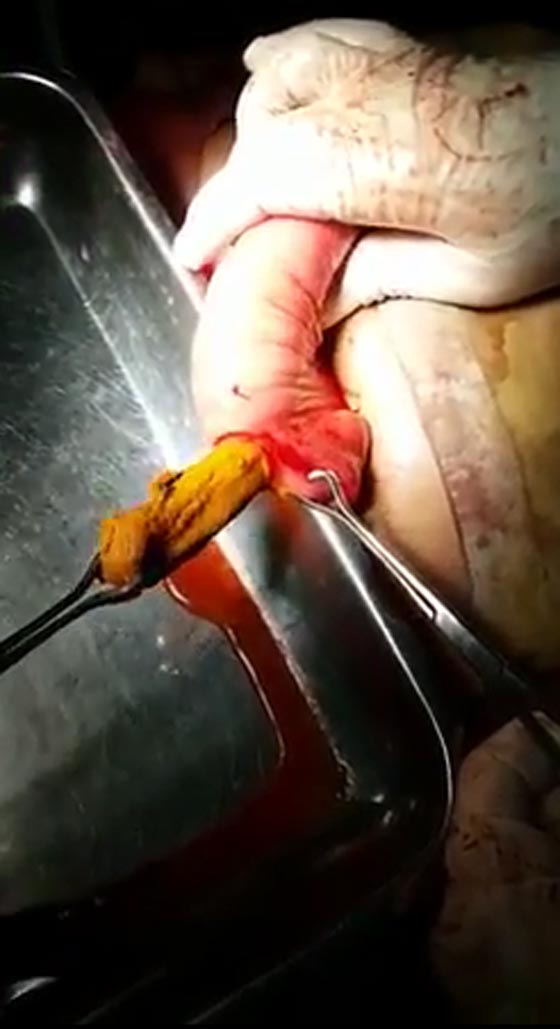 قطعة قماش في امعاء امرأة بعد 4 اشهر من عملية قيصرية.. فيديو صورة رقم 2