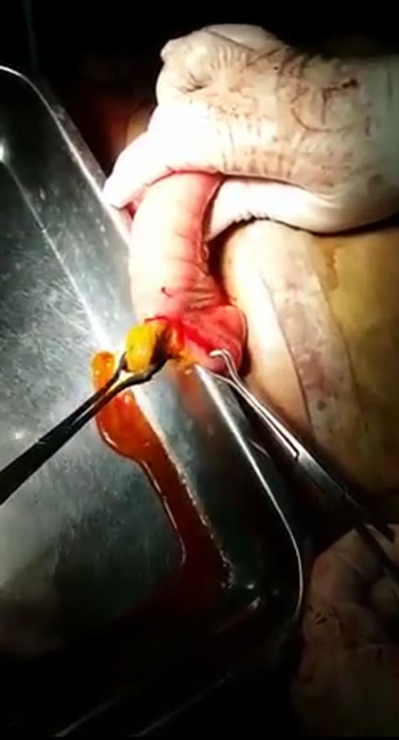 قطعة قماش في امعاء امرأة بعد 4 اشهر من عملية قيصرية.. فيديو صورة رقم 1