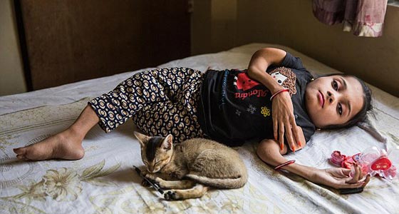  صور غريبة: مراهقة هندية كُسرت عظامها 1000 مرة بسبب مرض نادر  صورة رقم 1