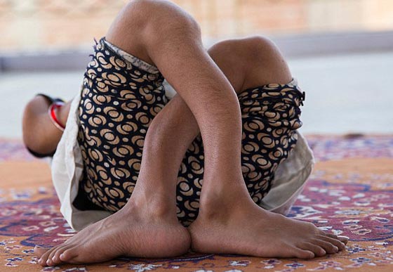  صور غريبة: مراهقة هندية كُسرت عظامها 1000 مرة بسبب مرض نادر  صورة رقم 2