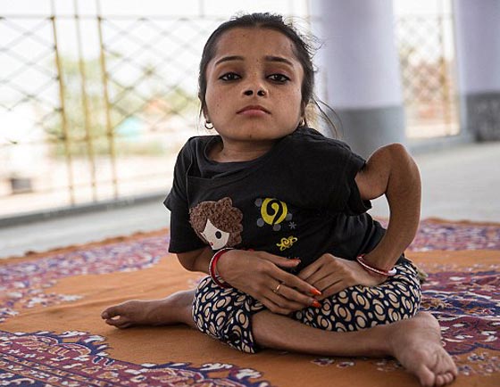  صور غريبة: مراهقة هندية كُسرت عظامها 1000 مرة بسبب مرض نادر  صورة رقم 3