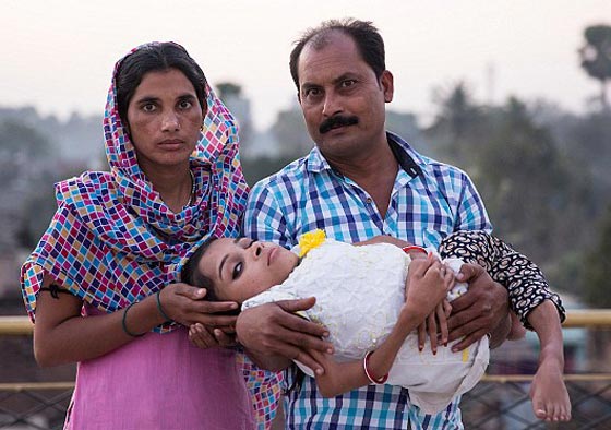  صور غريبة: مراهقة هندية كُسرت عظامها 1000 مرة بسبب مرض نادر  صورة رقم 5