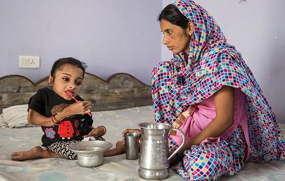  صور غريبة: مراهقة هندية كُسرت عظامها 1000 مرة بسبب مرض نادر  صورة رقم 6