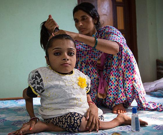  صور غريبة: مراهقة هندية كُسرت عظامها 1000 مرة بسبب مرض نادر  صورة رقم 8