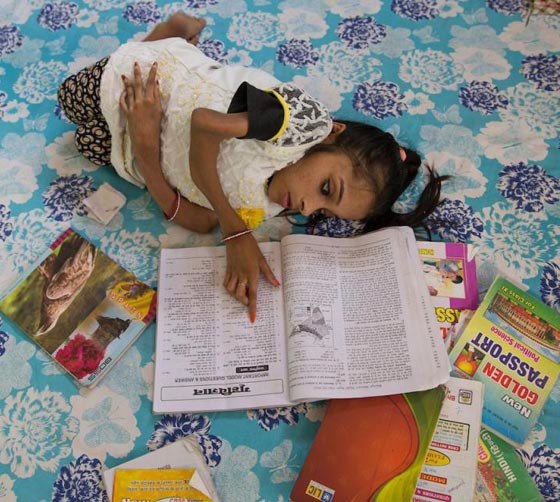  صور غريبة: مراهقة هندية كُسرت عظامها 1000 مرة بسبب مرض نادر  صورة رقم 9